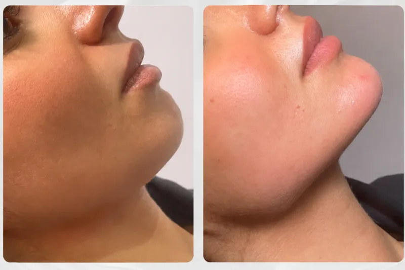 20% OFF RF Contour